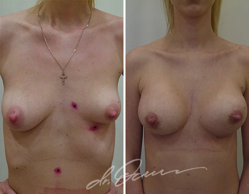 Увеличение груди  — хирург Осин М.А. 15.02.2018, фотография 1