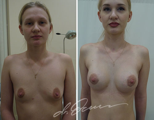 Увеличение груди  — хирург Осин М.А. 24.04.2018, фотография 1