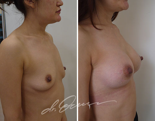 Увеличение груди  — хирург Осин М.А. 28.08.2018, фотография 1