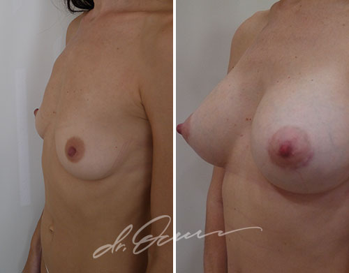 Увеличение груди  — хирург Осин М.А. 12.09.2018, фотография 1