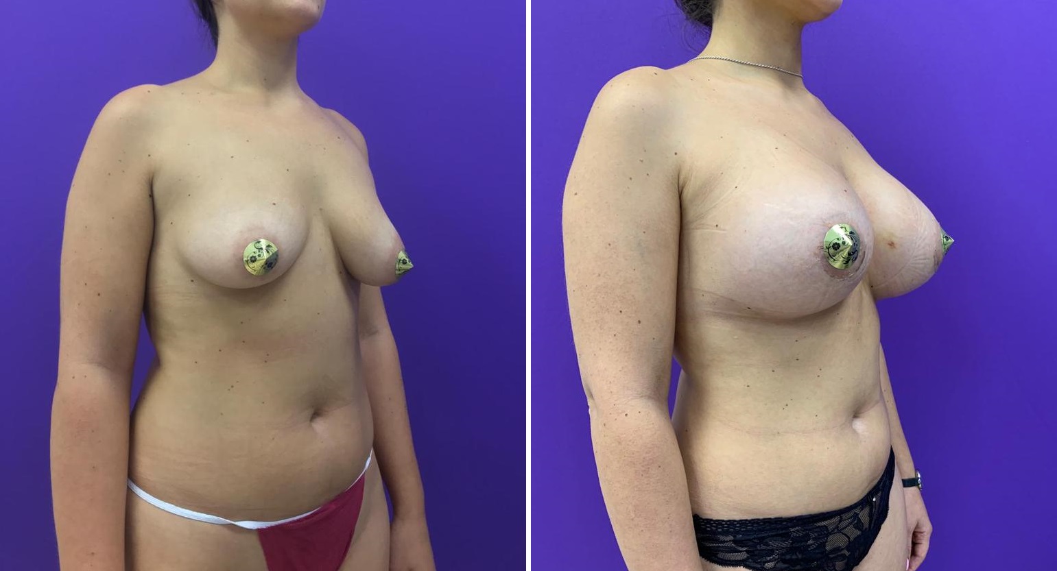 Увеличение груди  — хирург Осин М.А. 30.09.2019, фотография 1