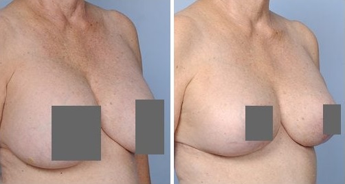 Подтяжка груди  — хирург Осин М.А. 26.04.2019, фотография 1