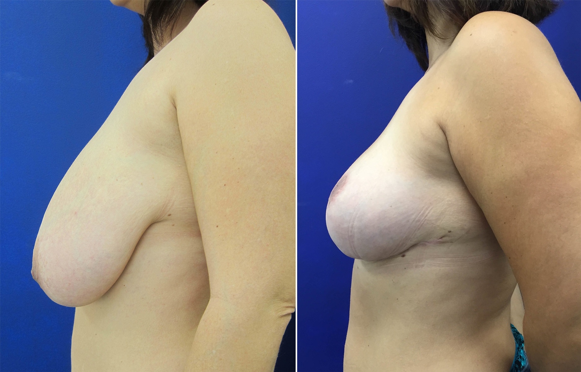 Подтяжка груди  — хирург Осин М.А. 14.05.2019, фотография 1
