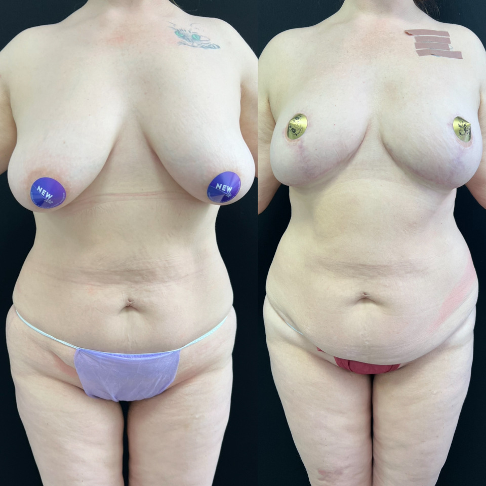 год с момента операции подтяжка груди без имплантов , фотография 1