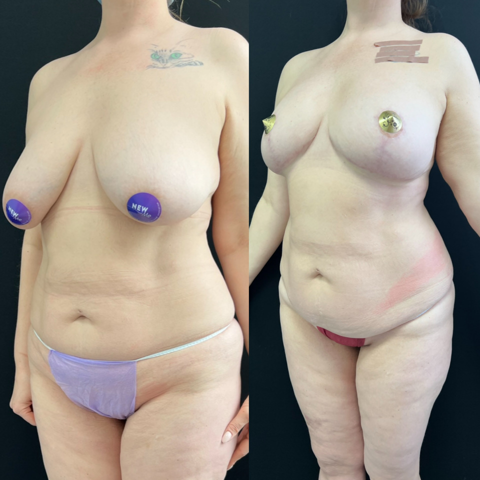 год с момента операции подтяжка груди без имплантов , фотография 3
