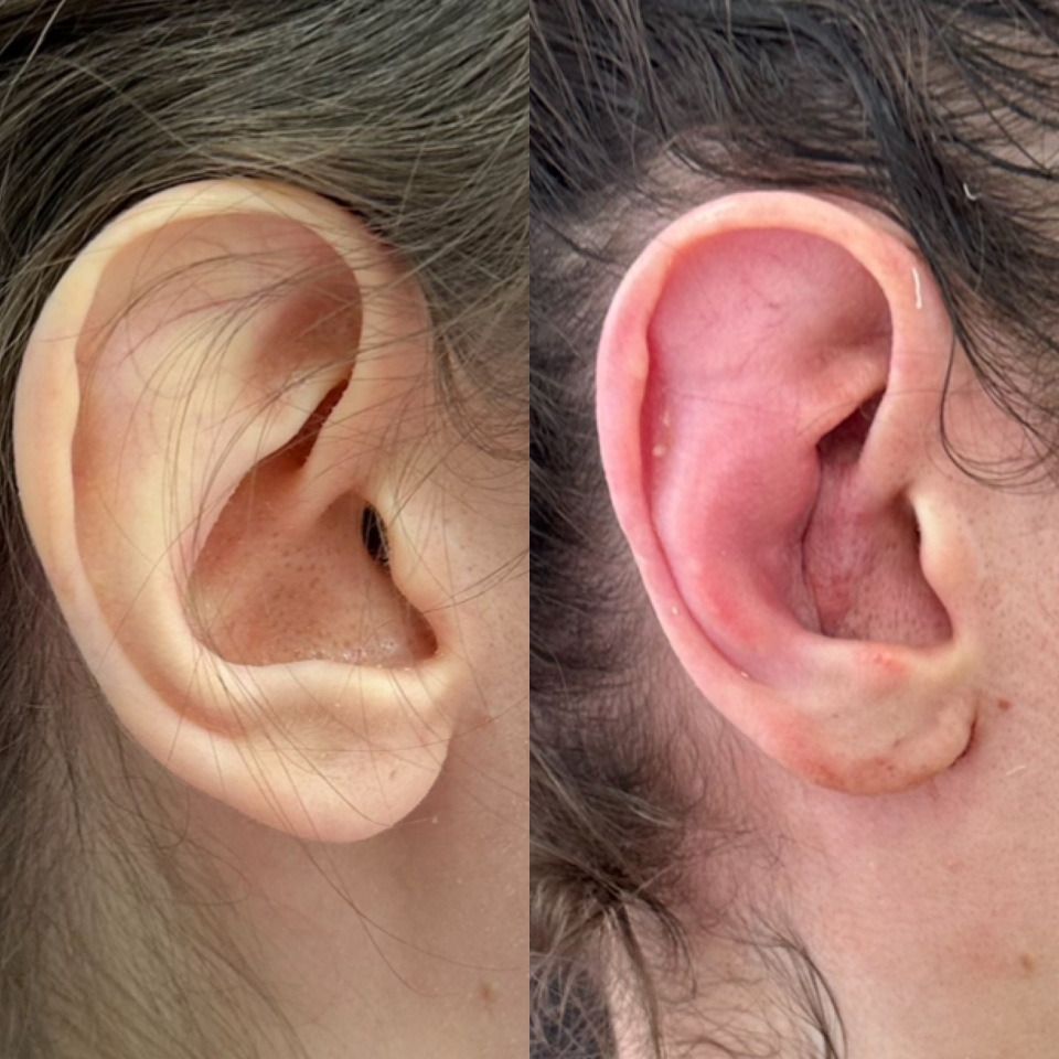 коррекция лопоухости с одновременным уменьшением размера уха, до /24 часа после операции , фотография 1