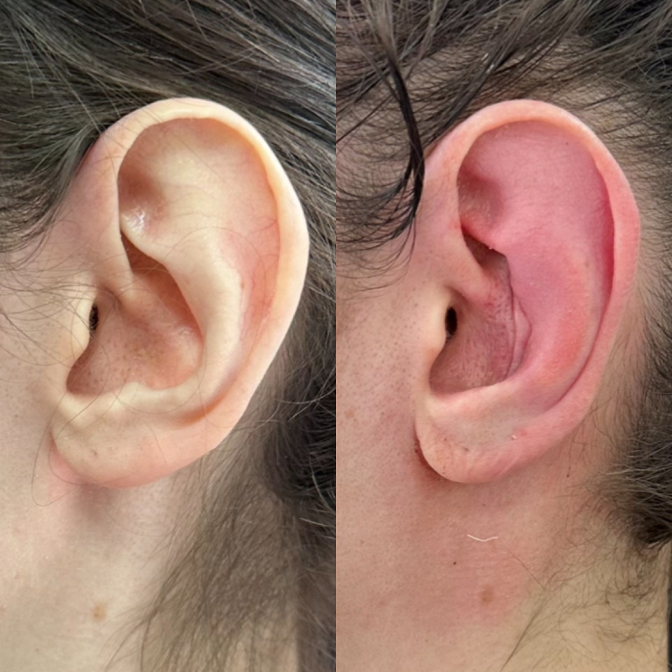 коррекция лопоухости с одновременным уменьшением размера уха, до /24 часа после операции , фотография 2