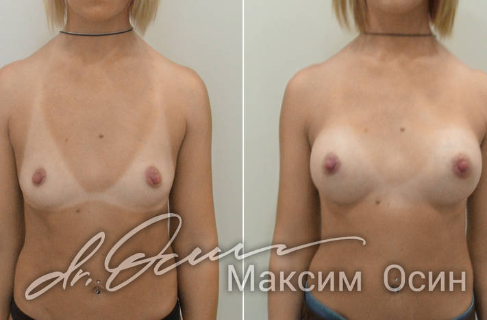 Фото пациентки до и после увеличения груди, фотография 1