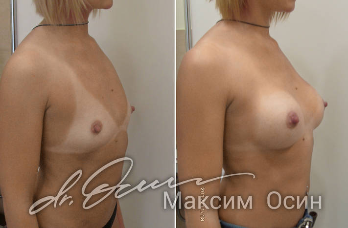 Фото пациентки до и после увеличения груди, фотография 2