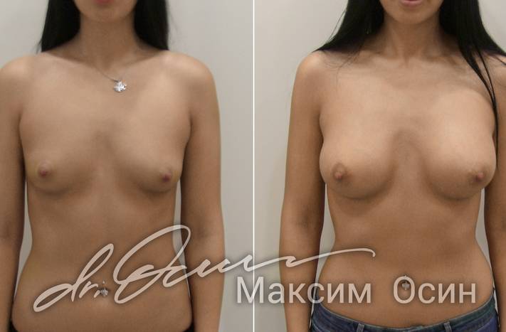 Пациентке проведена операция - увеличение груди., фотография 1
