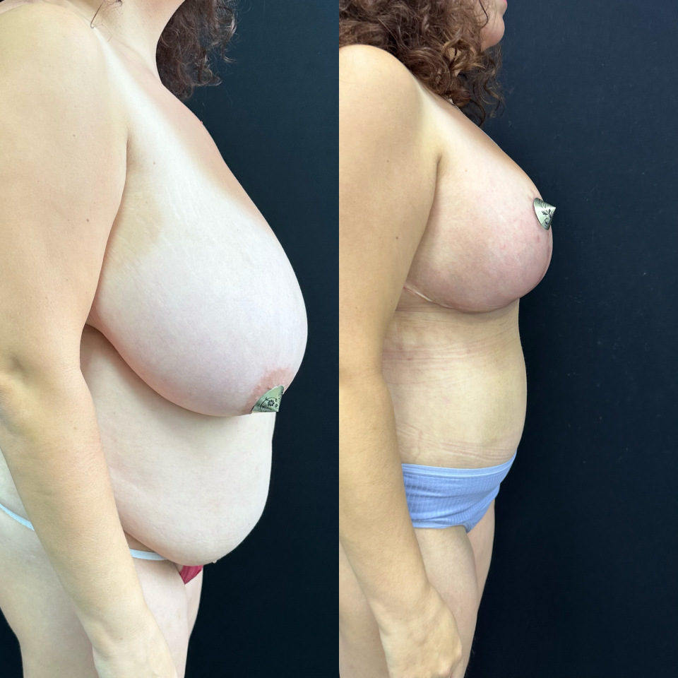 2 месяца с момента уменьшения груди в сочетании с абдоминопластикой , фотография 5