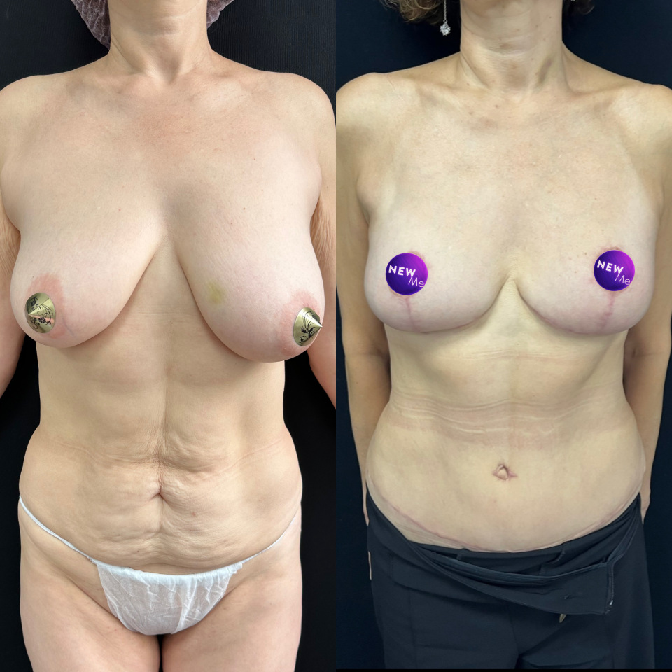 4 месяца с момента операции липоабдоминопластика с прорисовкой спортивного живота + подтяжка груди своими тканями , фотография 1