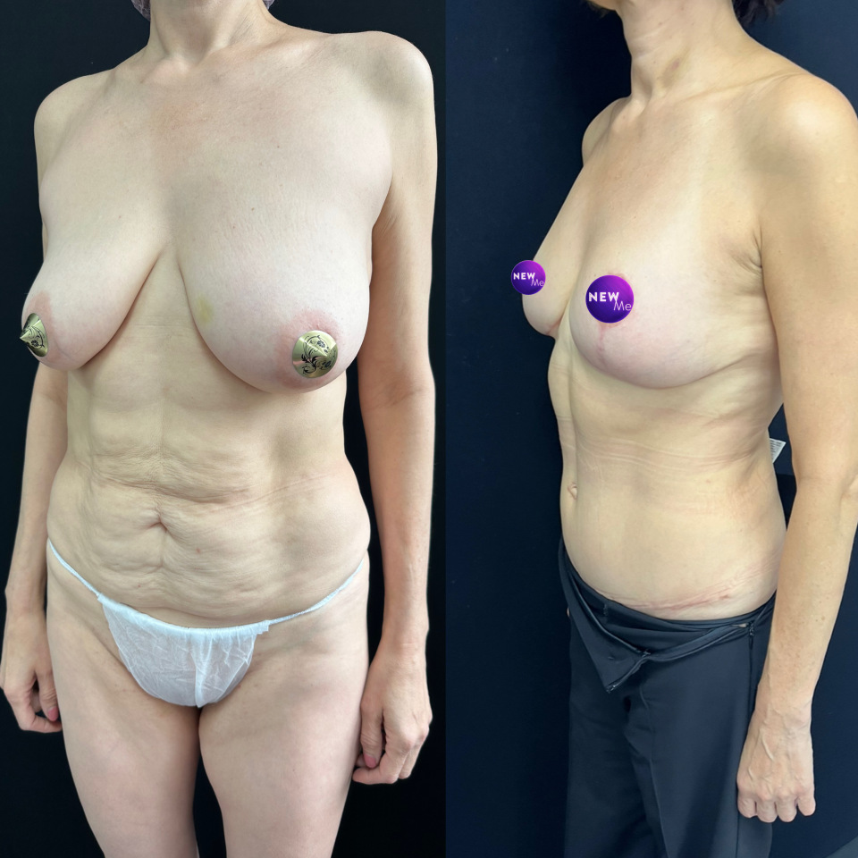 4 месяца с момента операции липоабдоминопластика с прорисовкой спортивного живота + подтяжка груди своими тканями , фотография 3